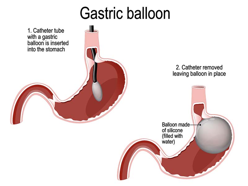 بالون معده برای لاغری