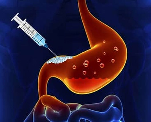 بوتاکس معده برای لاغری