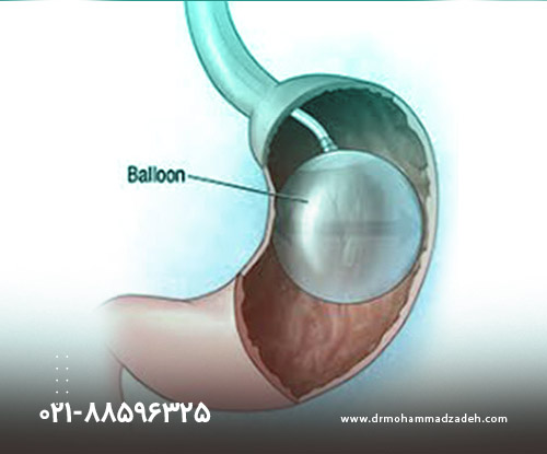 بالون معده برای لاغری سریع