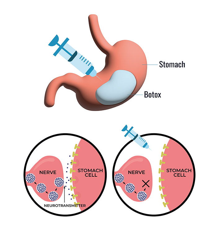 تزریق بوتاکس معده برای لاغری در تهران