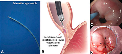 تزریق بوتاکس لاغری