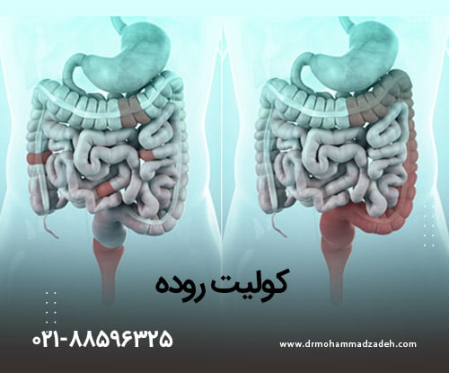 تفاوت بین روده سالم و روده مبتلا به کولیت