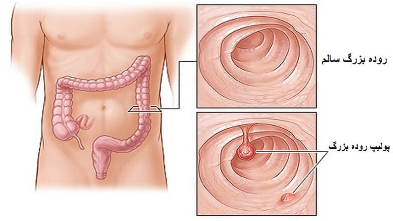 تفاوت روده سالم و پولیپ دار