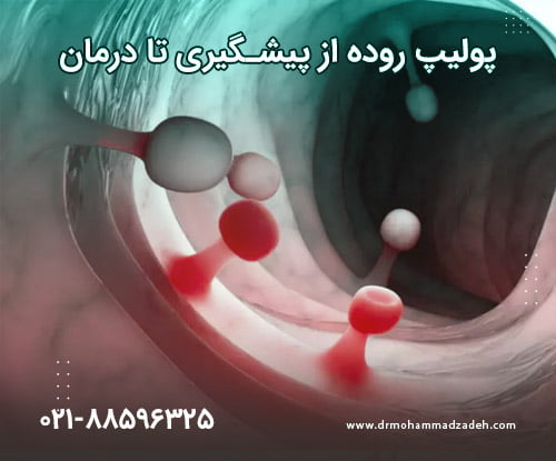 پولیپ روده از تشخیص تا درمان