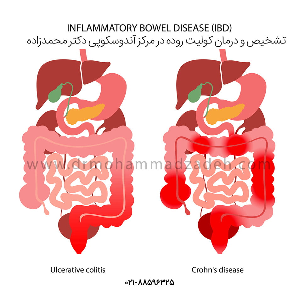 پیشگیری، تشخیص و درمان کولیت روده