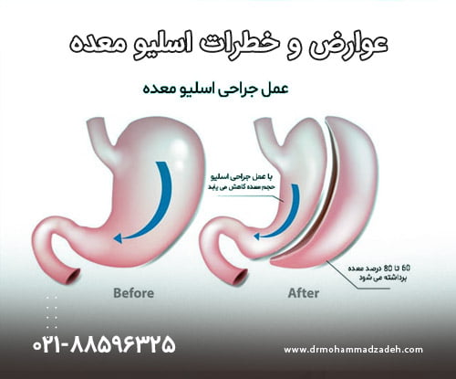 عوارض و خطرات اسلیو معده