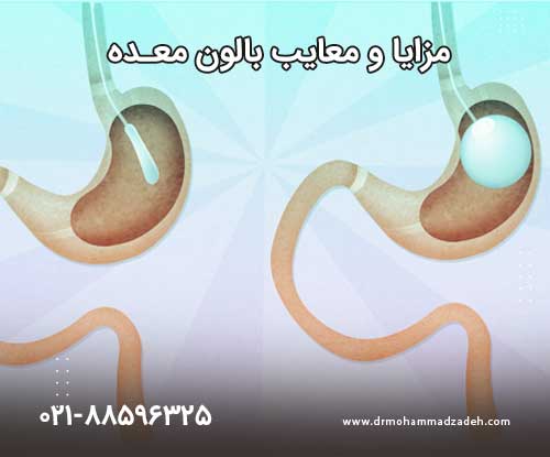 دکتر بالون معده