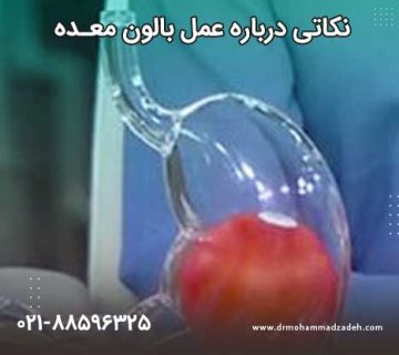 نکاتی درباره عمل بالون معده