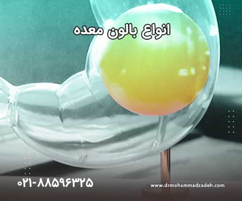 انواع بالون معده
