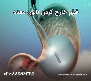 فیلم واقعی خارج کردن بالون معده