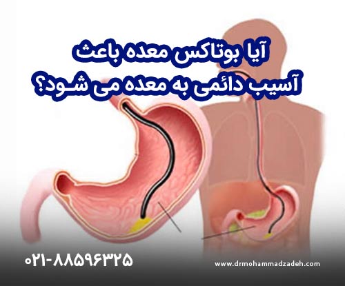 آیا بوتاکس معده باعث آسیب دائمی به معده می شود؟