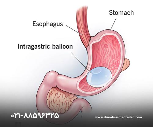 تاثیر مثبت بالون گذاری معده روی لاغری سریع
