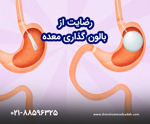 رضایت از بالون معده