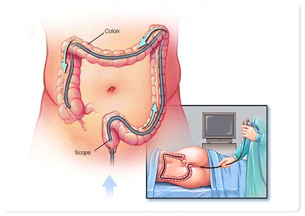 اقدامات پس از کولونوسکوپی