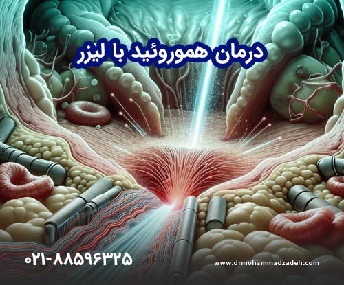 درمان هموروئید با لیزر