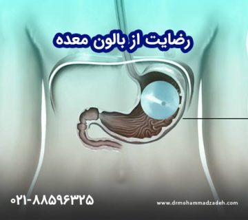 رضایت از بالون معده