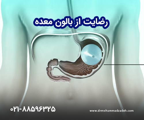 رضایت از بالون معده