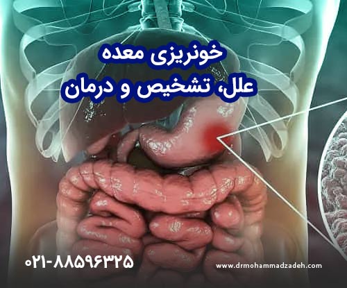 خونریزی معده | علل، تشخیص و درمان
