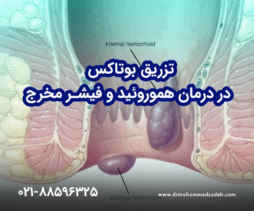 تزریق بوتاکس در درمان هموروئید و فیشر مخرج