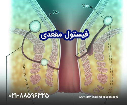 فیستول مقعدی