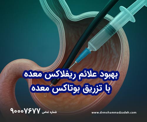 بهبود علائم ریفلاکس معده با تزریق بوتاکس معده