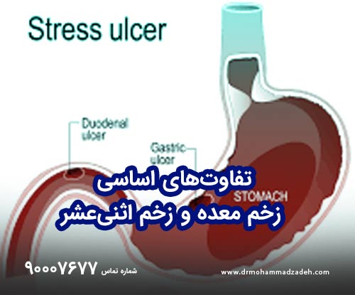 تفاوتهای اساسی زخم معده و زخم اثنیعشر