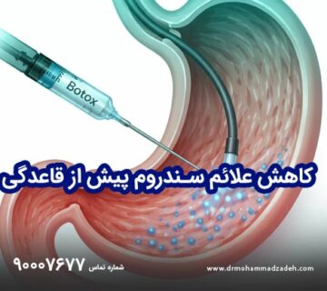 بوتاکس معده و کاهش علائم سندروم پیش از قاعدگی