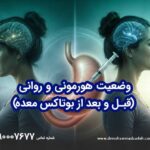 تأثیرات بر خلق و خواب با بوتاکس معده