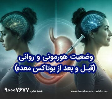 تأثیرات بر خلق و خواب با بوتاکس معده