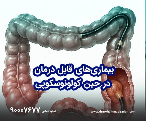 بیماری‌های قابل درمان در حین کولونوسکوپی