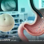 بوتاکس معده بعد از جراحی شکم