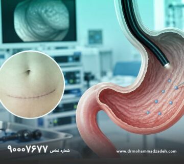 بوتاکس معده بعد از جراحی شکم