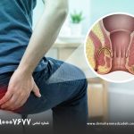 ترشح بعد از عمل فیستول مقعدی تا چند وقت طبیعی است
